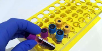 Situación insostenible en los laboratorios clínicos de los centros sanitarios de Andalucía por la aparición de ómicron