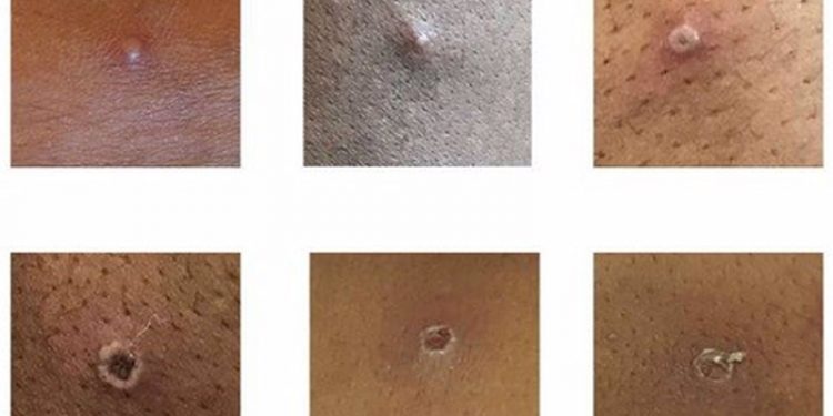 Detectado en Málaga un posible primer de viruela del mono en Andalucía