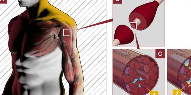 Los afectados por la enfermedad de Pompe piden «equidad» en el acceso al tratamiento